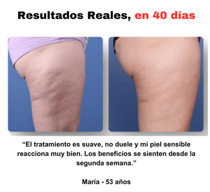 SmoothGlow - Masajeador Anticelulítico| Desintoxica y suaviza la piel